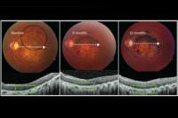 Стволовые клетки вылечили тяжелые болезни глаз