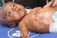  Индийские врачи расследуют случай "вспыхивающего" младенца
